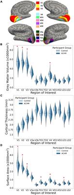 Structural Differences Across Multiple Visual Cortical Regions in the Absence of Cone Function in Congenital Achromatopsia